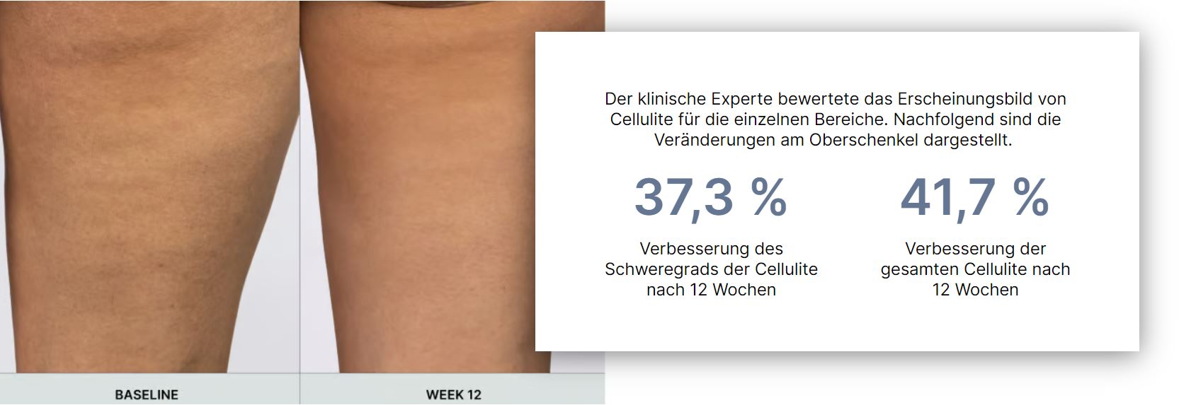 Ergebnisse von WellSpa iO - weniger Cellulite