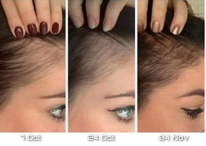 Przed i po zdjęciach wzrostu włosów po zastosowaniu kuracji do włosów Nutriol i Galvanic Spa